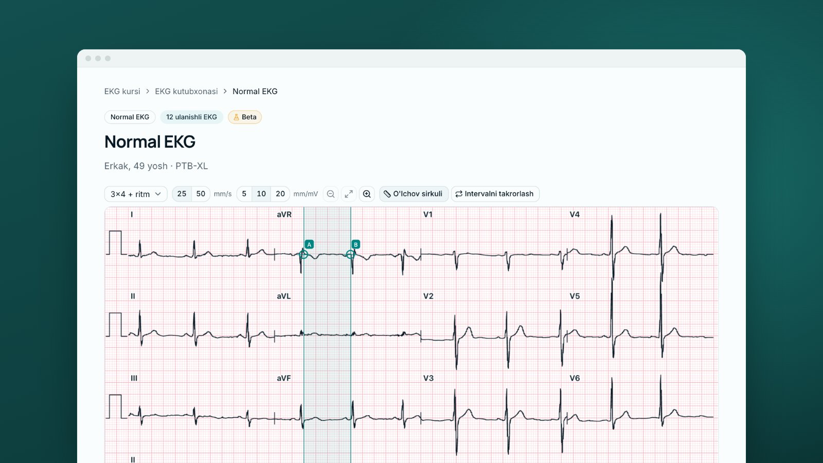 EKG kutubxonasidagi 12 ulanishli normal EKG