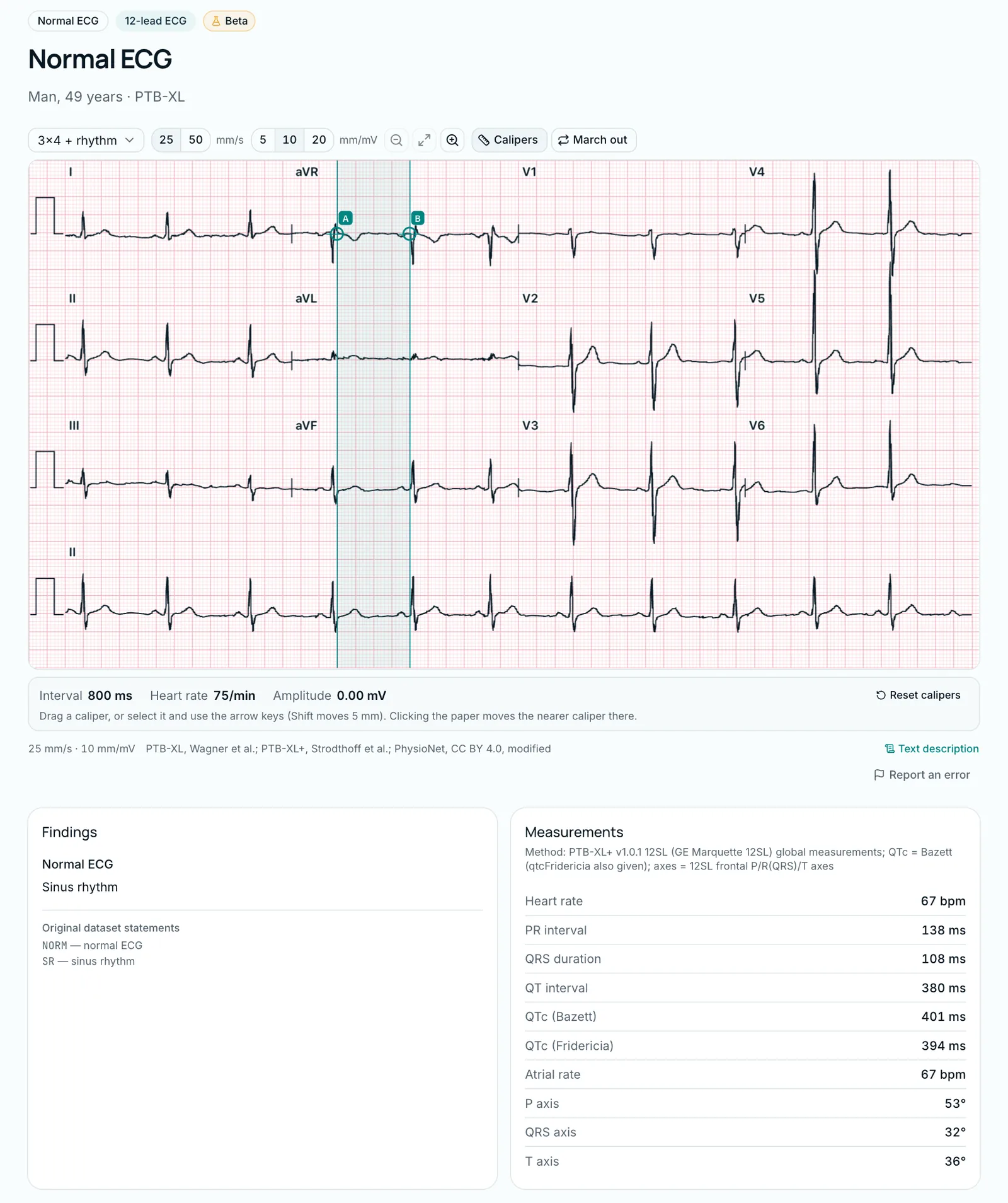 ECG library: the normal 12-lead ECG of a 49-year-old man with its measurements