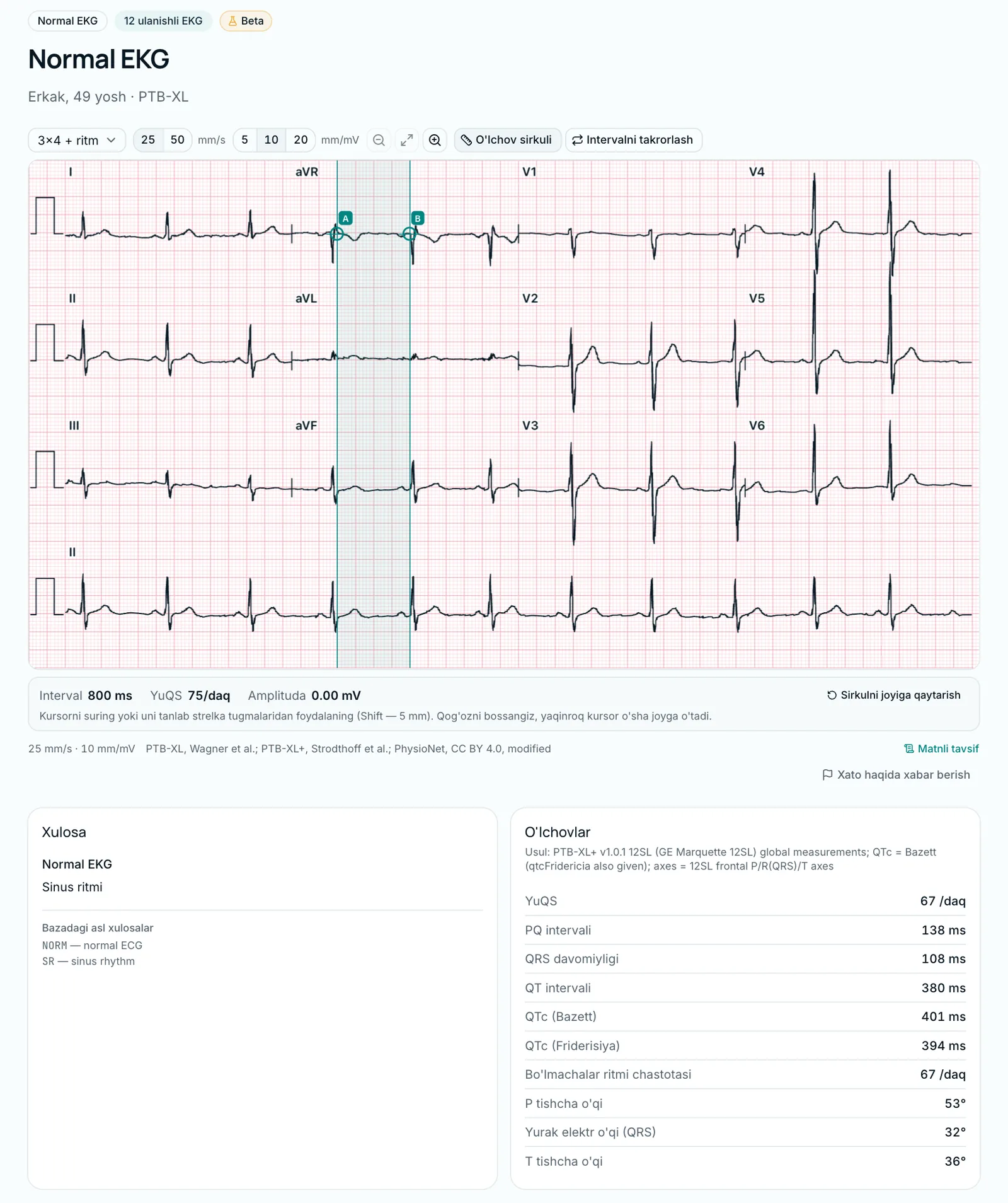 EKG kutubxonasi: 49 yoshli erkakning normal 12 ulanishli EKGsi va o'lchovlari