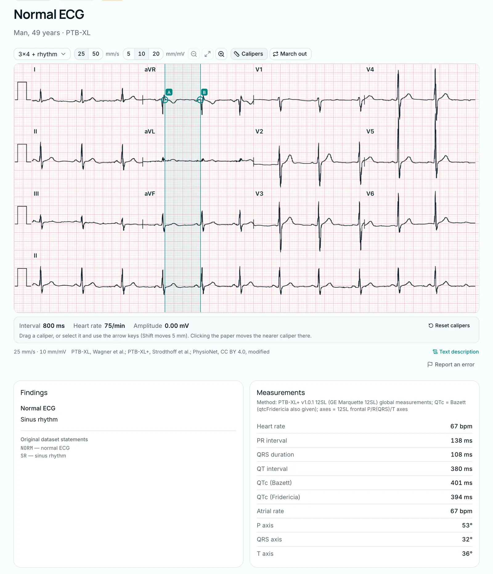 Normal 12-lead ECG in the library with the measurements card